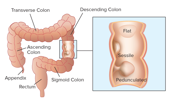 polyps